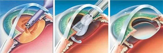 Phacoemulsification Eye Surgery